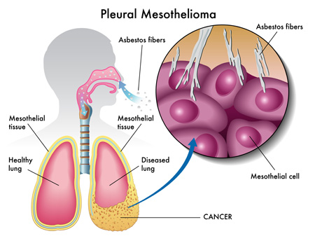 how is mesothelioma transmitted