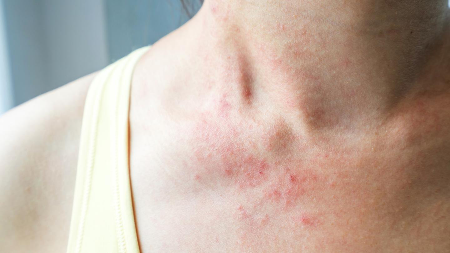 Preventing Mold Rash